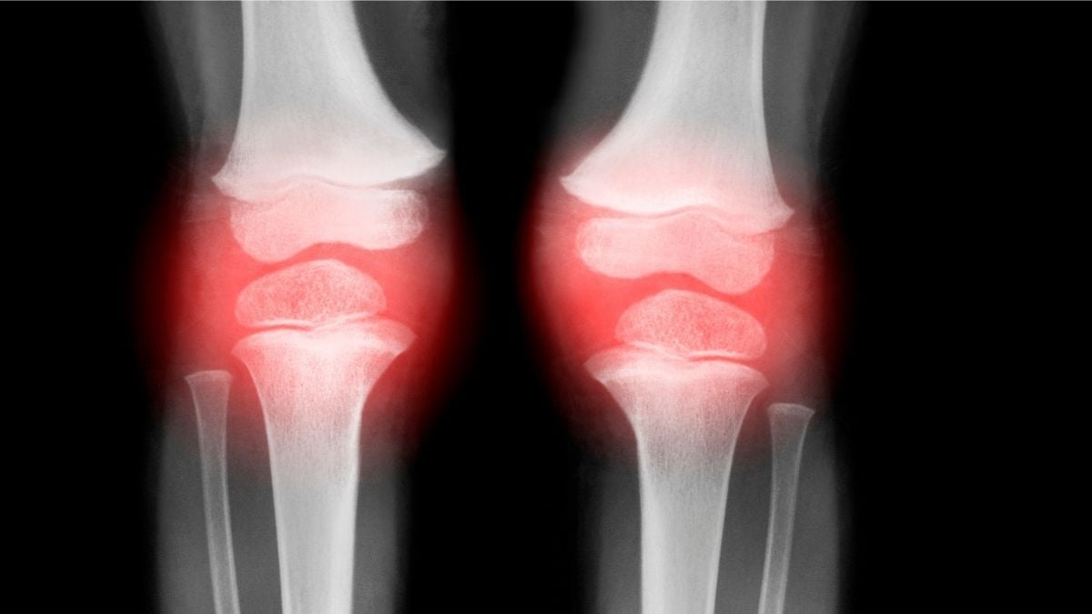 Single Injection Successfully Reverses Osteoarthritis in Animals Within 4 Weeks