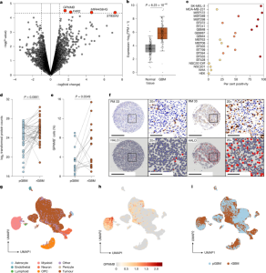 Targeting glioblastoma with CAR-T cells that focus on GPNMB in dual tumors