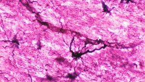 Two Individuals with Serious Autoimmune Disease in Recovery After Immune 'Reset'