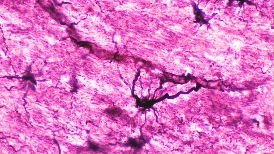 Two Individuals with Serious Autoimmune Disease in Recovery After Immune 'Reset'