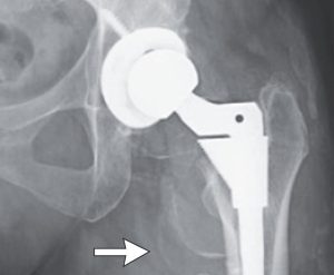Woman's hip surgery fails, leading to serious metal poisoning.
