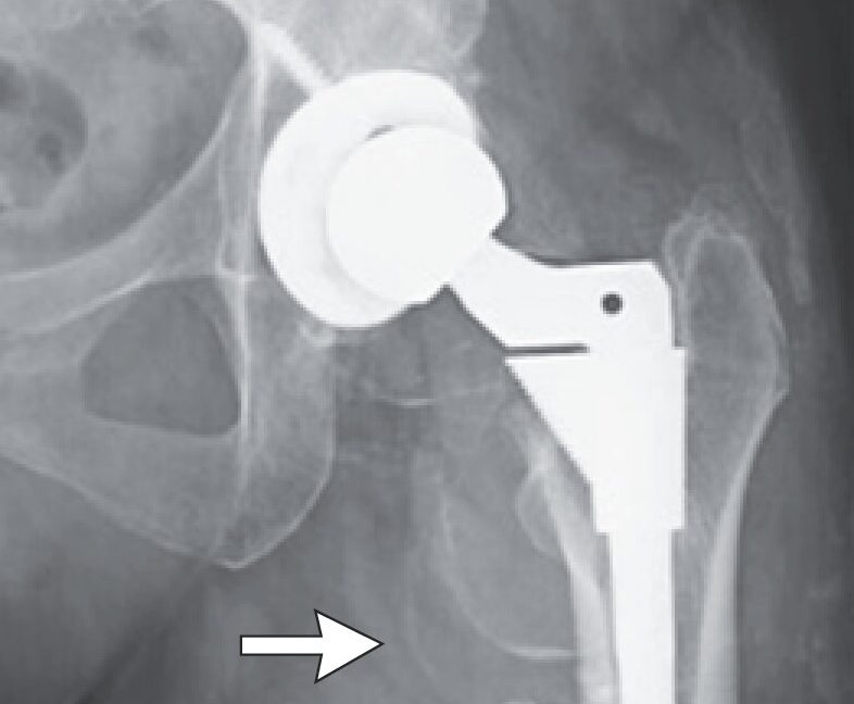 Woman's hip surgery fails, leading to serious metal poisoning.