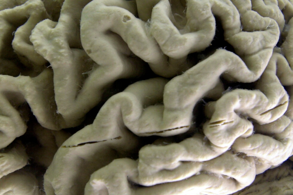 A blood test could forecast the onset of Alzheimer's symptoms years ahead of time.