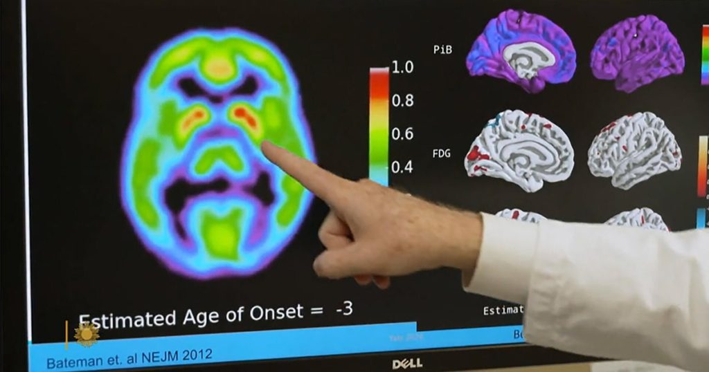 Blood test for Alzheimer's could identify individuals at risk of developing symptoms in 5 to 10 years.
