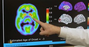 Blood test for Alzheimer's could identify individuals at risk of developing symptoms in 5 to 10 years.