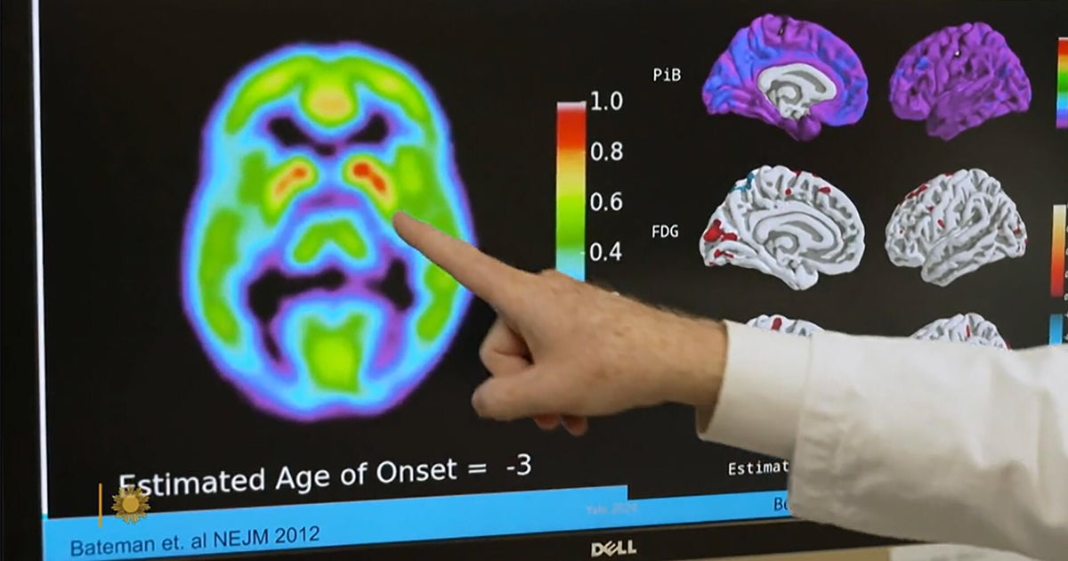Blood test for Alzheimer's could identify individuals at risk of developing symptoms in 5 to 10 years.