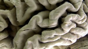 Blood test may help detect individuals at high risk for Alzheimer's, research indicates