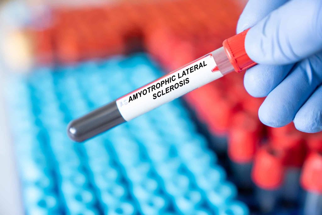 Can Blood Tests Forecast ALS Before It Occurs? Here’s What Researchers Discovered