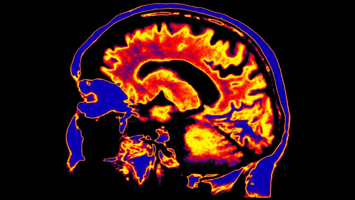 Chronic Fatigue Syndrome Connected to the Brain's Waste Removal System for the First Time