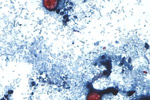 Cyclospora cases rise sharply as Michigan points to lettuce as the cause