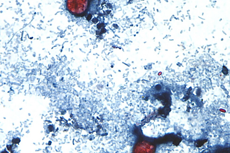 Cyclospora cases rise sharply as Michigan points to lettuce as the cause