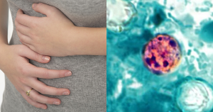 Cyclosporiasis: California now seeing reports of diarrhea cases