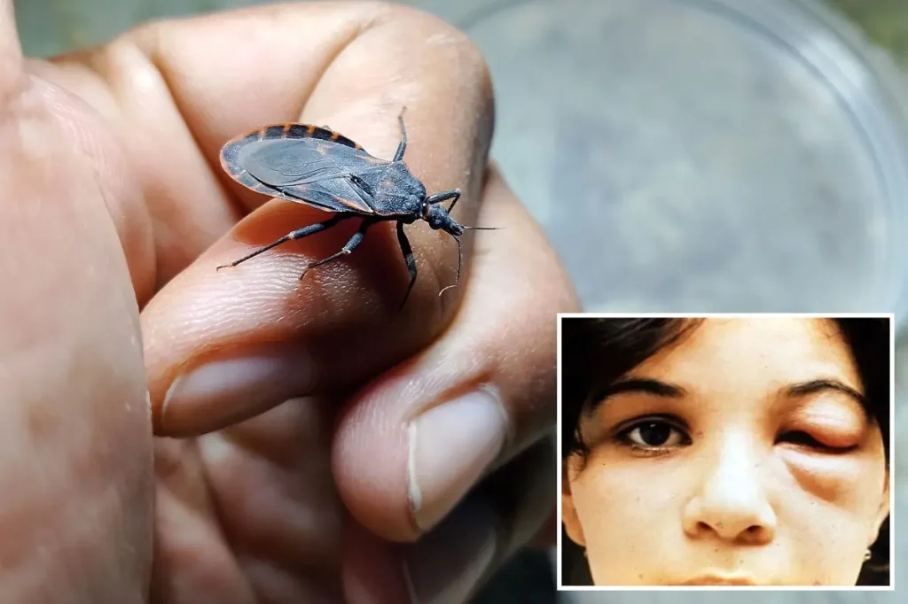 Deadly 'kissing bug' discovered in California, and those affected might be unaware