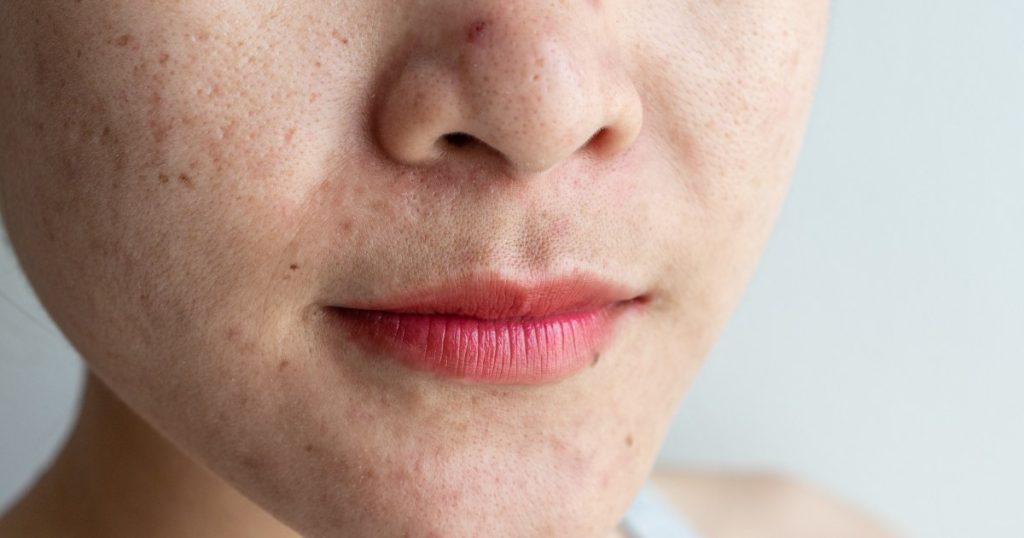 Dermatologist Shares Top Skin Sign That May Indicate Heart Problems