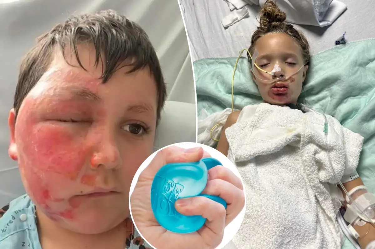 Doctor alerts that the viral NeeDoh toy trend is causing serious burn injuries in children.