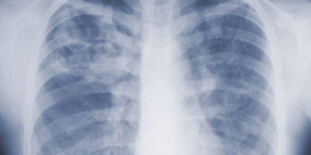 First CDC study on mold reveals it's more dangerous than we realized