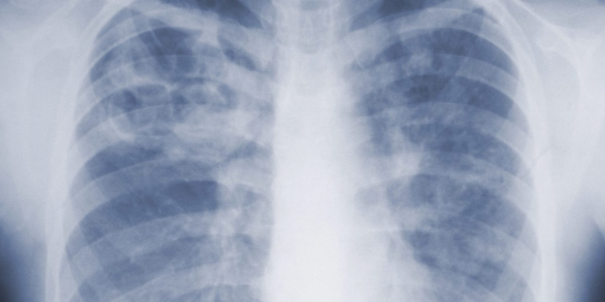 First CDC study on mold reveals it's more dangerous than we realized