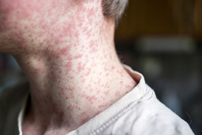 Maryland reports 3 additional measles cases and alerts about potential exposures.