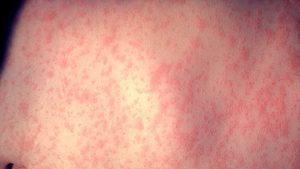 Measles in Iowa: Find out where you might have been exposed to the virus