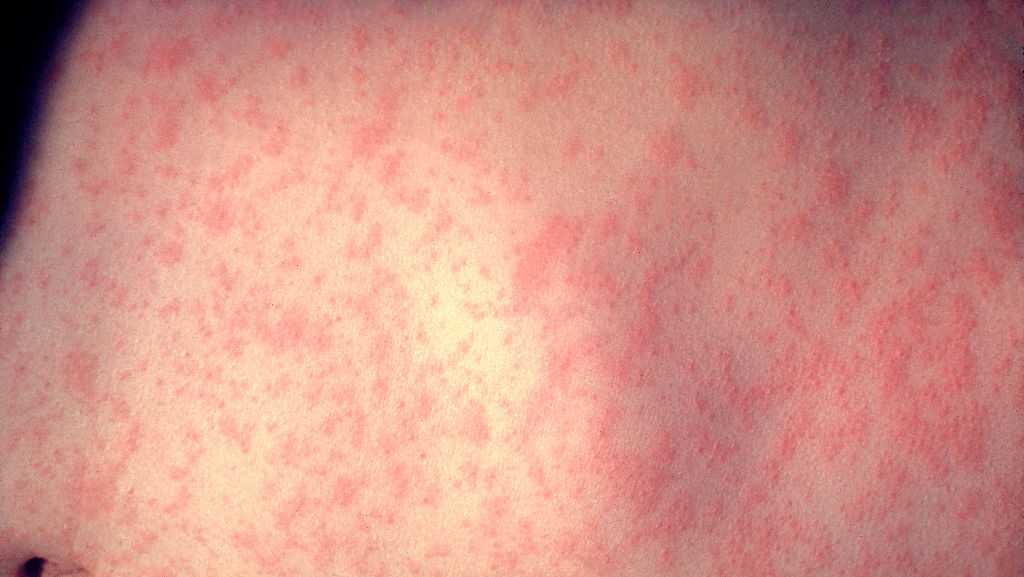 Measles in Iowa: Find out where you might have been exposed to the virus