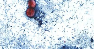 Missouri experiences rise in cyclospora infections.