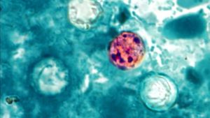 Oklahoma reports 172 cases of cyclosporiasis, according to health officials