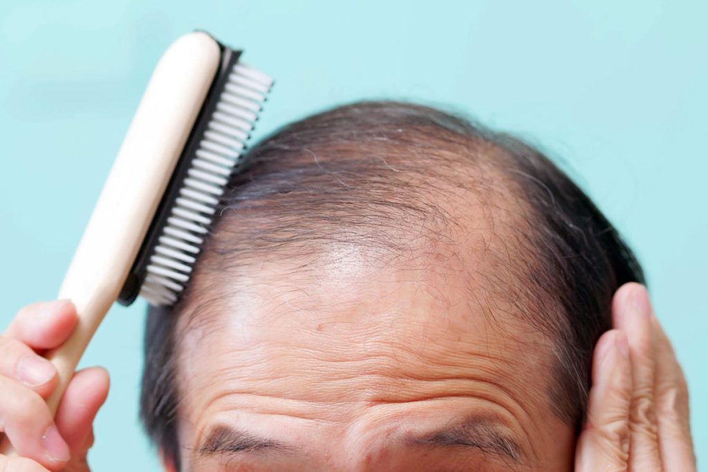 Research reveals connection between weight loss medications and hair loss.