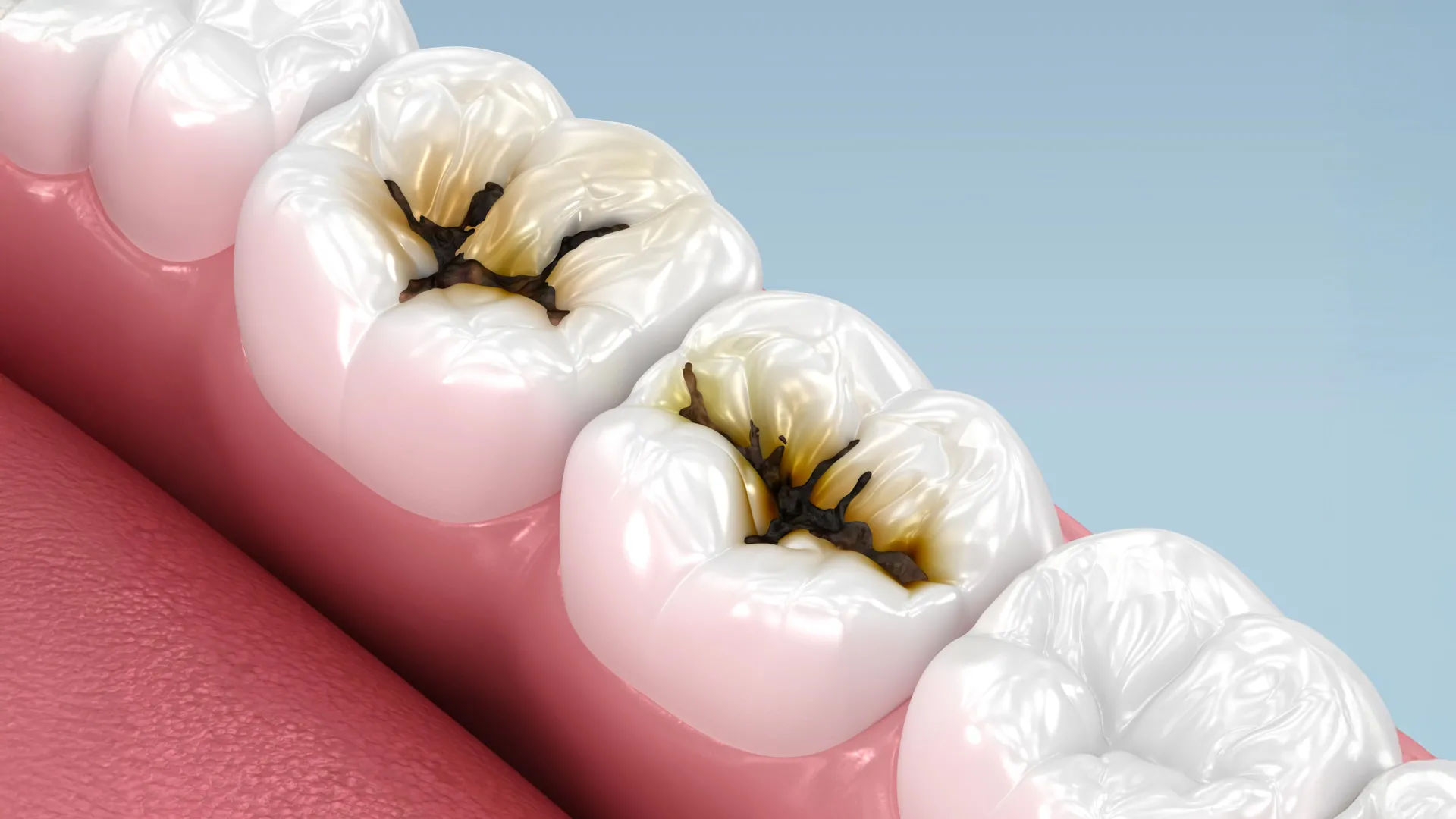 Researchers discover an easy method to prevent cavities without using drills