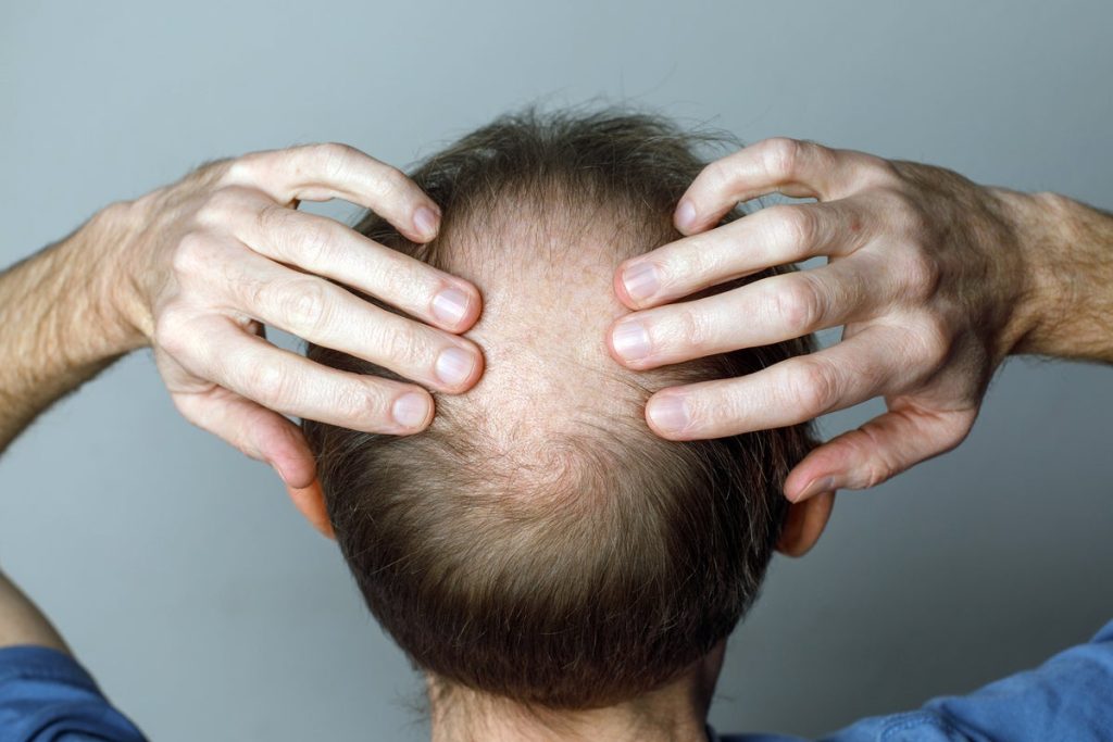 Study finds connection between weight loss medications and hair loss