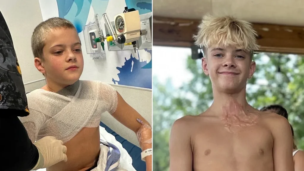 Teen suffers third-degree burns from popular NeeDoh microwave trend