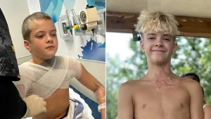 Teen suffers third-degree burns from popular NeeDoh microwave trend