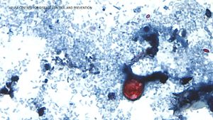 This is where cyclosporiasis is spreading, with cases reported in 32 states including California; a symptom is watery diarrhea.