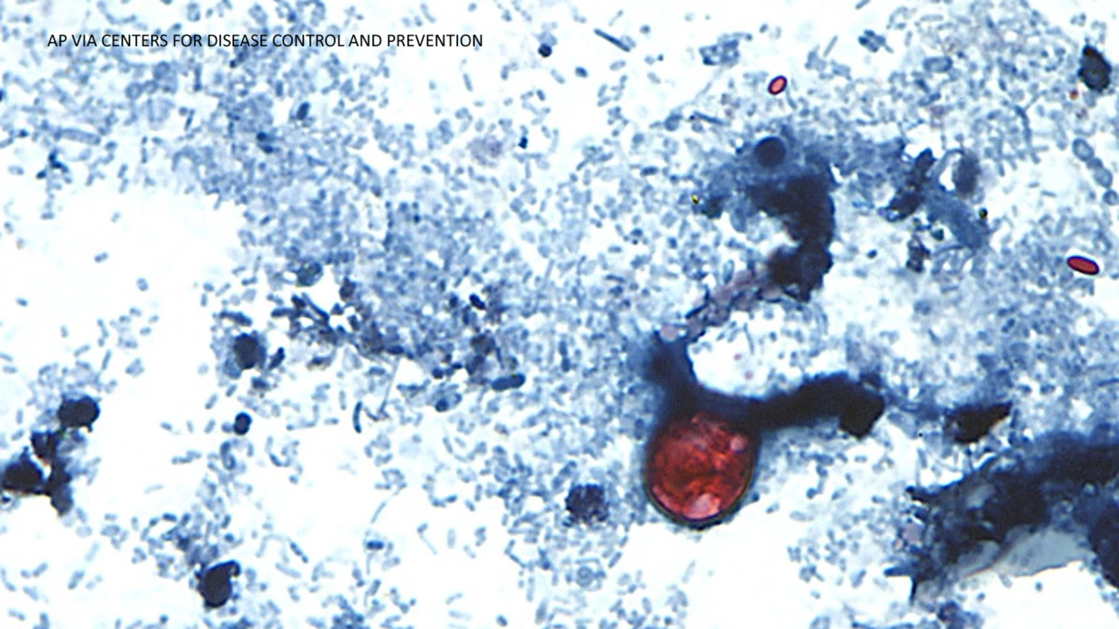 This is where cyclosporiasis is spreading, with cases reported in 32 states including California; a symptom is watery diarrhea.