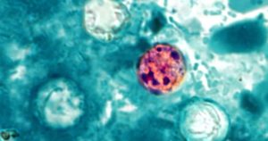 Understanding cyclosporiasis: symptoms, case numbers, map, and updates as parasite outbreaks spread to 31 states