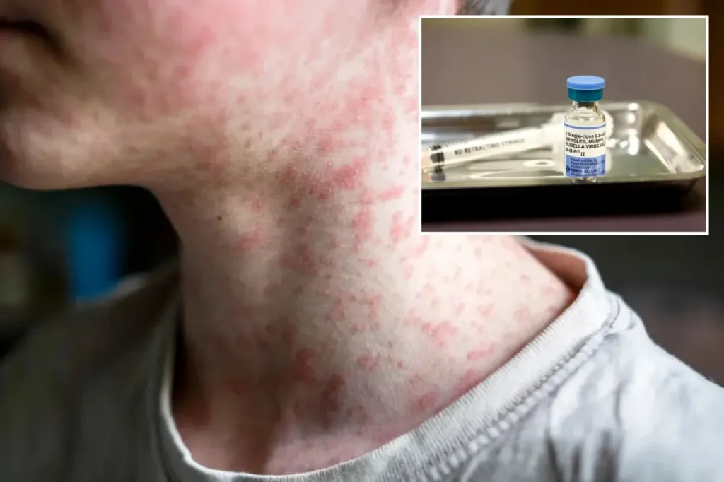 US reports highest number of cases of the world&rsquo;s most contagious illness in 35 years