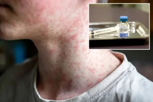 US reports highest number of cases of the world’s most contagious illness in 35 years