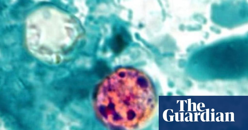 What is cyclosporiasis, the parasitic disease that leads to severe diarrhea?