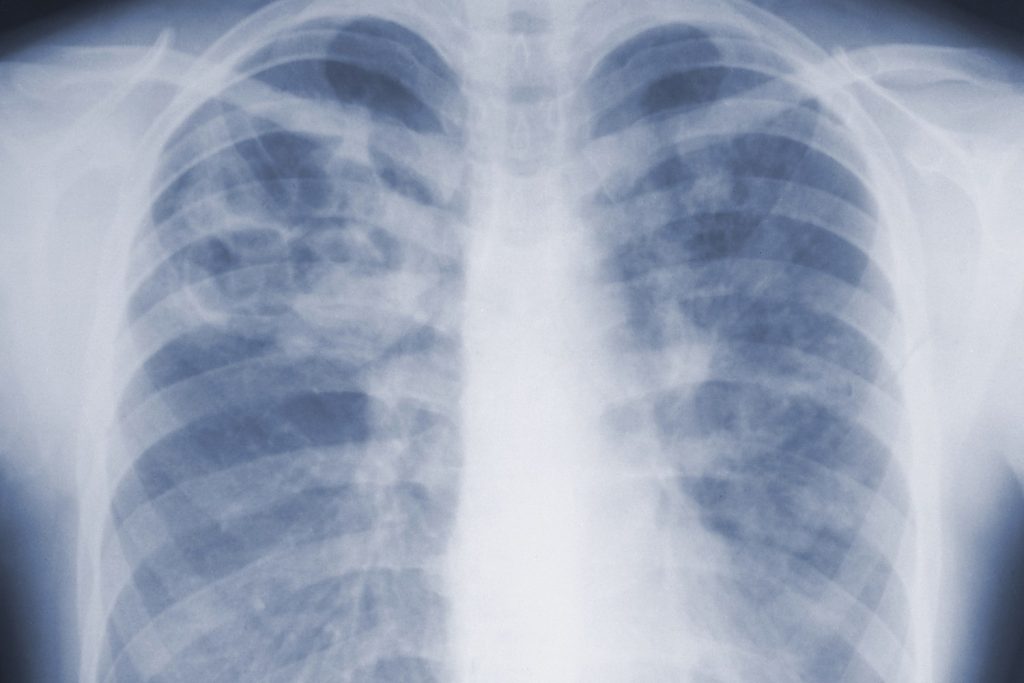 A lung cancer scan saved his life years after he stopped smoking.