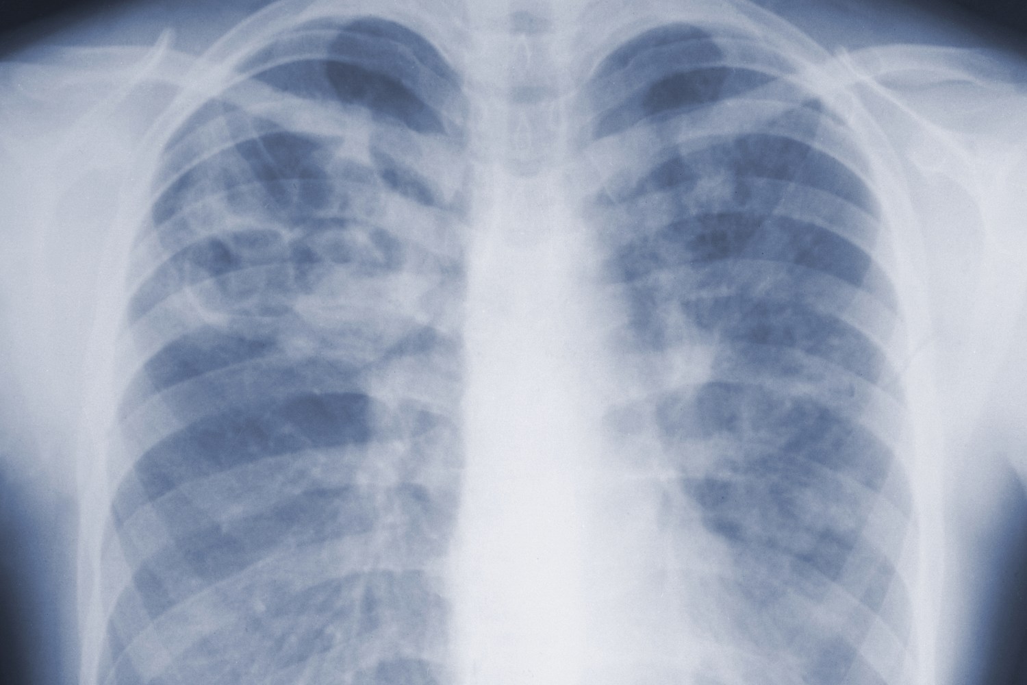 A lung cancer scan saved his life years after he stopped smoking.