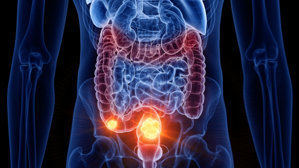 More young people are being diagnosed with a certain type of cancer, and it is puzzling researchers.
