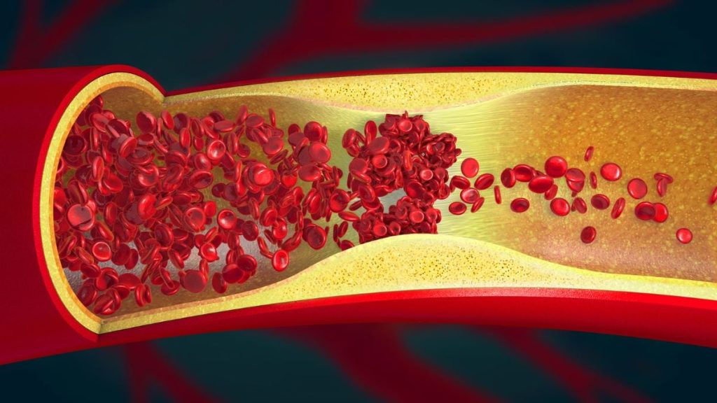 Researchers Discover Evidence of Artery Damage in Almost 80% of Young Adults