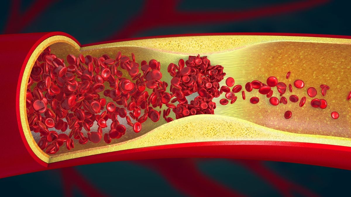 Researchers Discover Evidence of Artery Damage in Almost 80% of Young Adults
