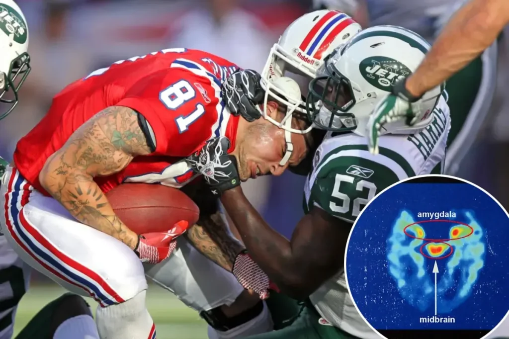 Study finds a troublingly high number of former NFL players develop CTE.