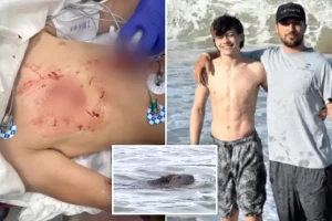 Boy bitten by an infected beaver at Cunningham Falls State Park has several surgeries.