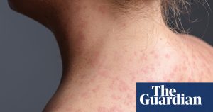 California alerts about measles risk in six counties due to unvaccinated train traveler