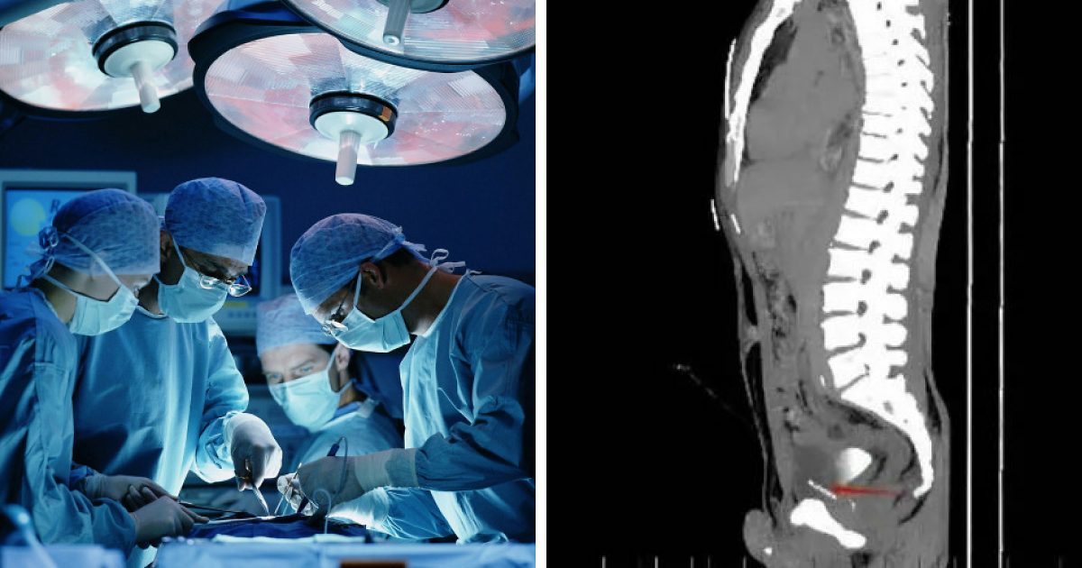 Doctors Find Troubling 'Foreign Objects' in Man's Chest, Pelvis, Bladder, and Genitals at Hospital