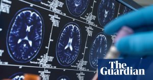 Experts caution that social media is leading to the harmful misuse of blood tests for Alzheimer’s.