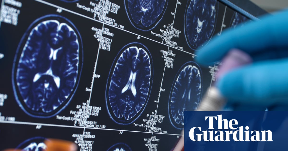 Experts caution that social media is leading to the harmful misuse of blood tests for Alzheimer&rsquo;s.