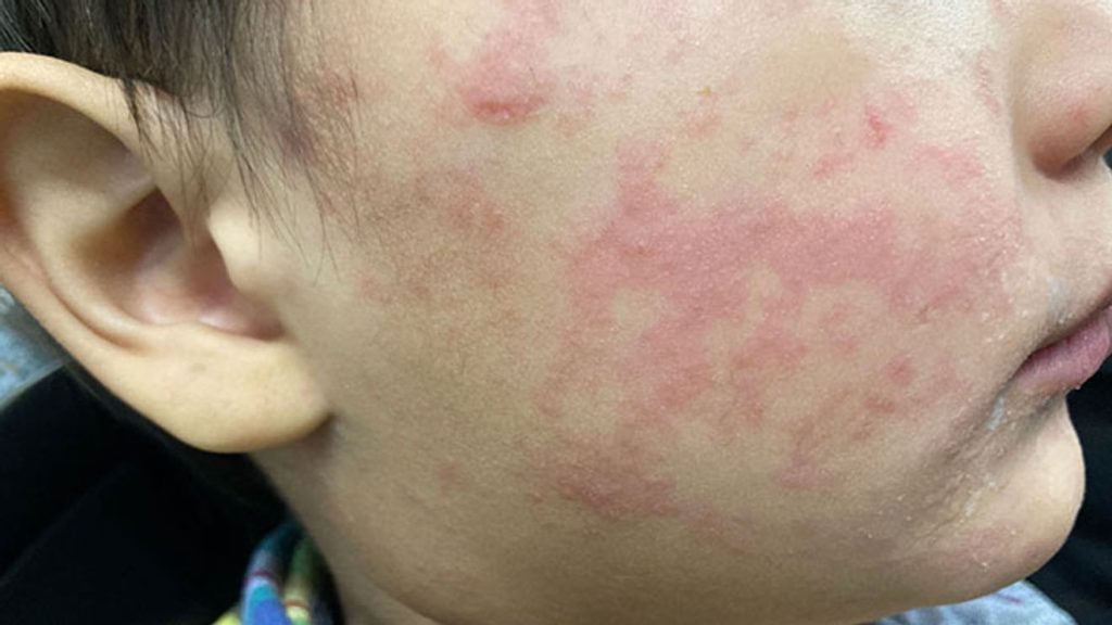 Gas station in Hendersonville and hotel in Asheville marked as locations for potential measles exposure