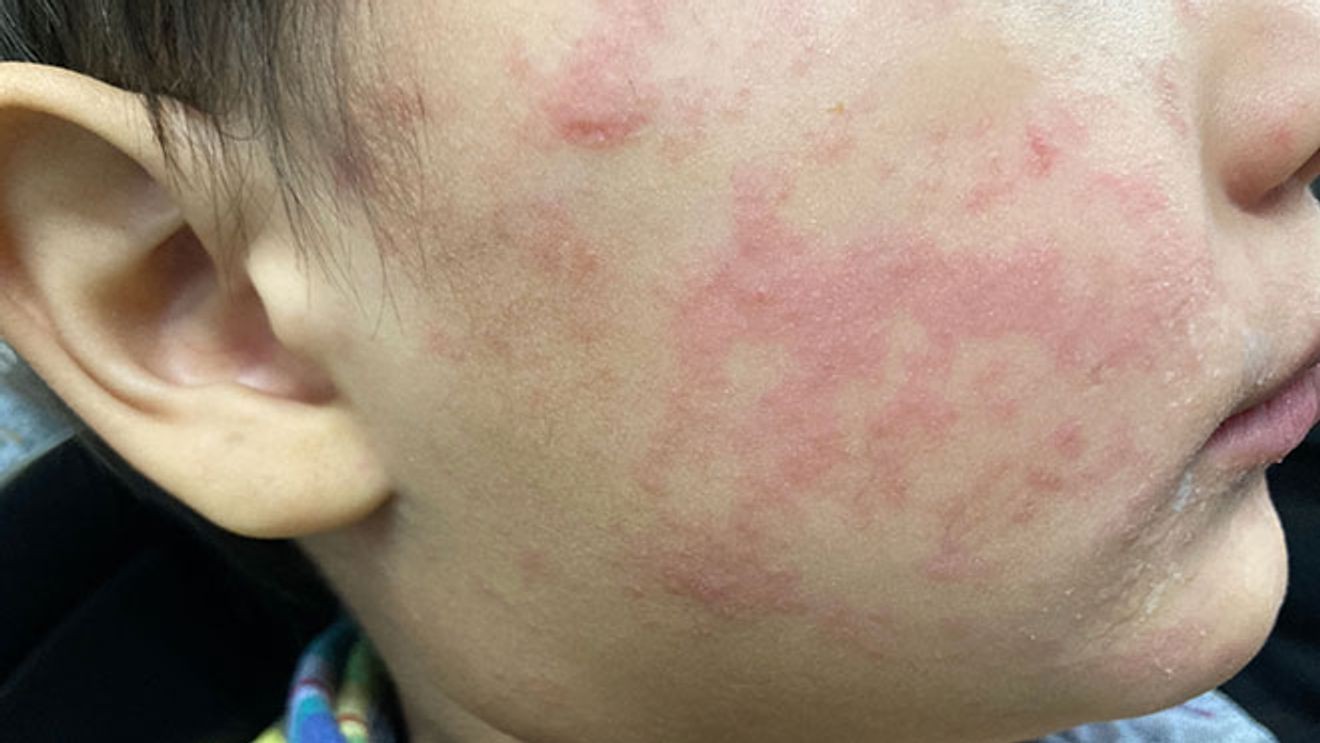 Gas station in Hendersonville and hotel in Asheville marked as locations for potential measles exposure